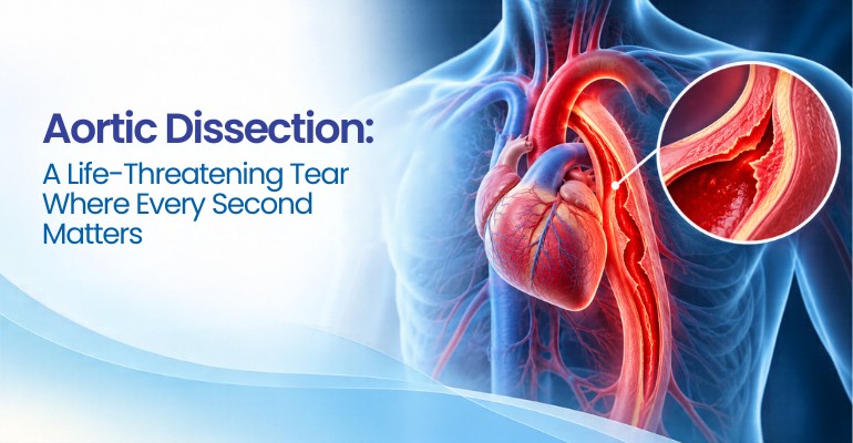 Aortic Dissection: A Life-Threatening Tear Where Every Second Matters